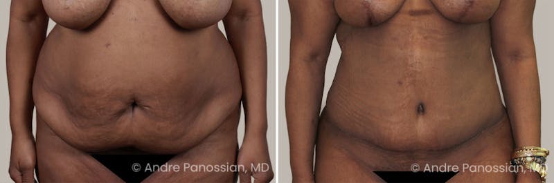 Tummy Tuck Before & After Gallery - Patient 295910 - Image 1