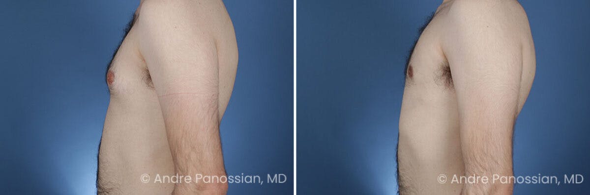 Male Breast Reduction (Gynecomastia) Before & After Gallery - Patient 228752 - Image 3