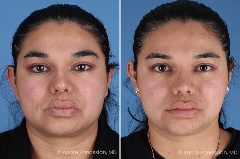 Selective Neurolysis Before & After Gallery - Patient 335645 - Image 1