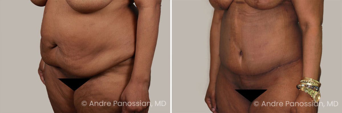 Tummy Tuck Before & After Gallery - Patient 295910 - Image 2