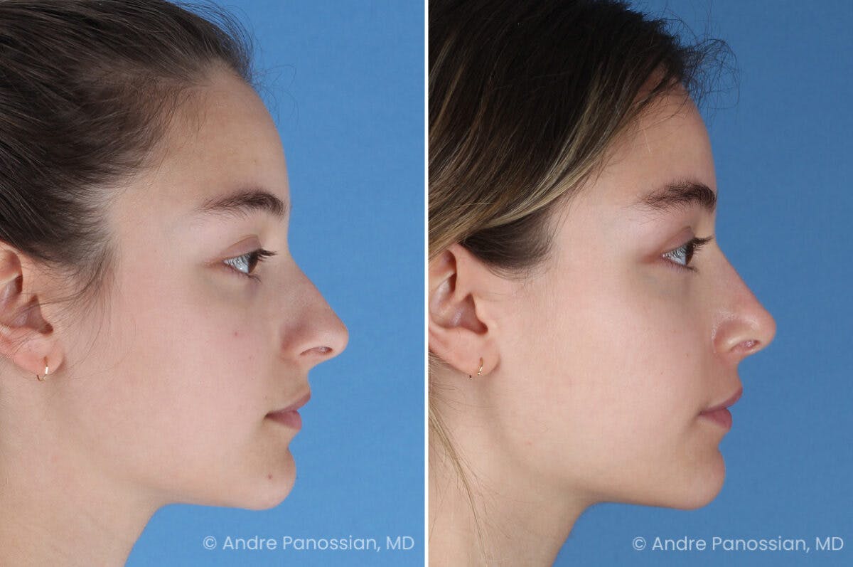 Rhinoplasty Before & After Gallery - Patient 321162 - Image 1