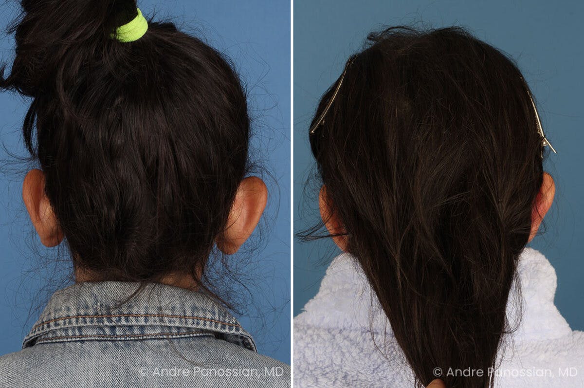 Ear Pinning (Otoplasty) Before & After Gallery - Patient 129093 - Image 3