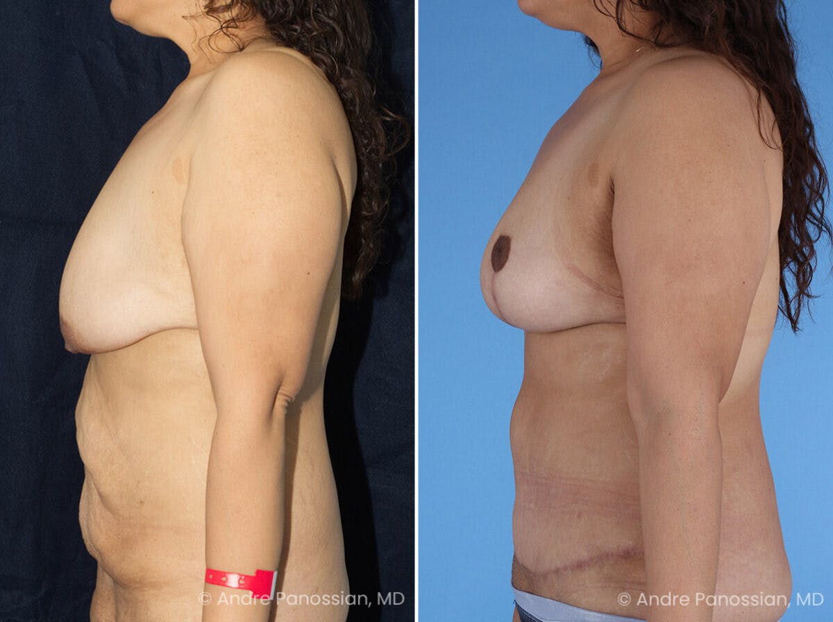 Mommy Makeover Before & After Gallery - Patient 114158 - Image 5