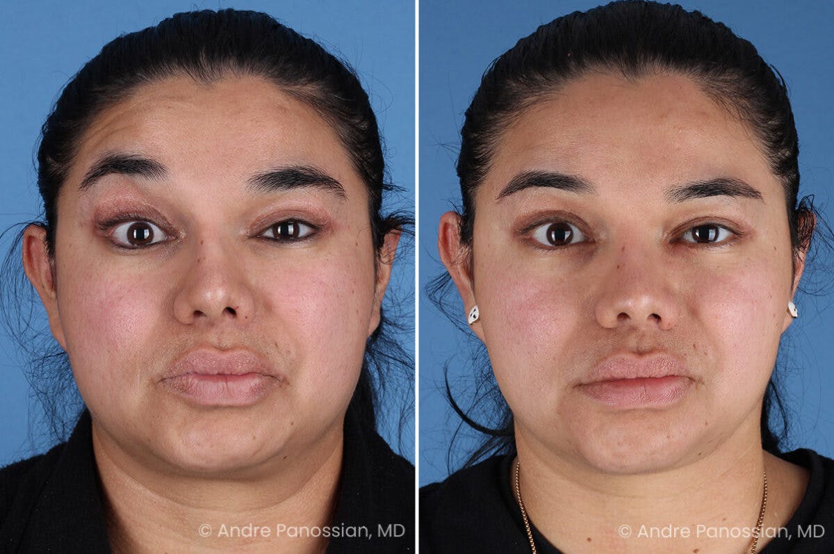 Selective Neurolysis Before & After Gallery - Patient 335645 - Image 2