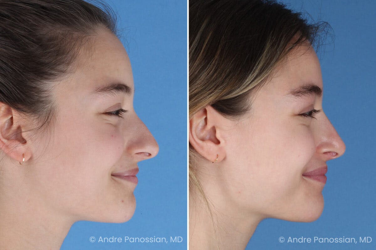 Rhinoplasty Before & After Gallery - Patient 321162 - Image 4