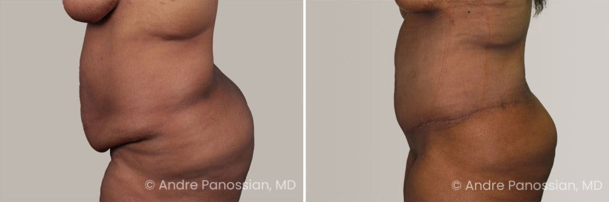 Tummy Tuck Before & After Gallery - Patient 295910 - Image 3