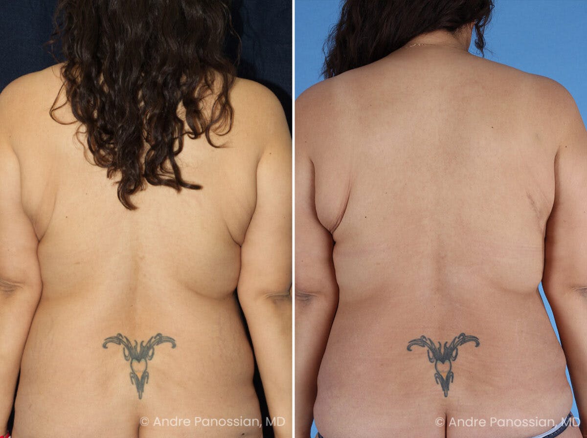 Mommy Makeover Before & After Gallery - Patient 114158 - Image 6