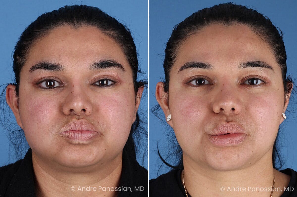 Selective Neurolysis Before & After Gallery - Patient 335645 - Image 3