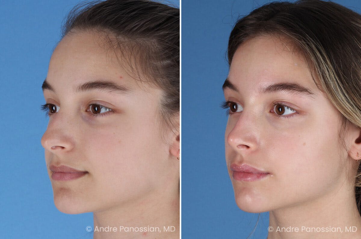 Rhinoplasty Before & After Gallery - Patient 321162 - Image 5