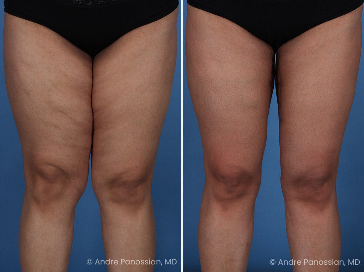 Thighplasty Before & After Gallery - Patient 175563 - Image 1