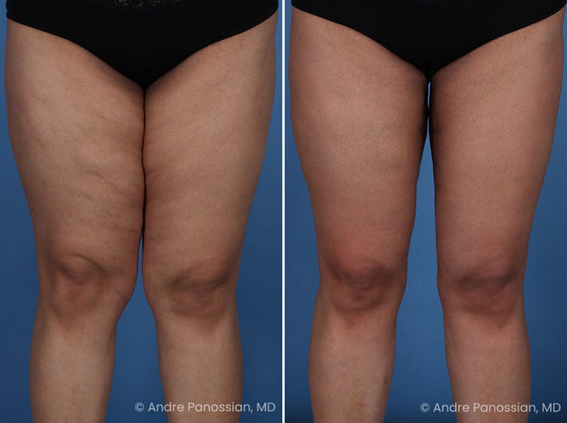 Thighplasty Before & After Gallery - Patient 175563 - Image 1