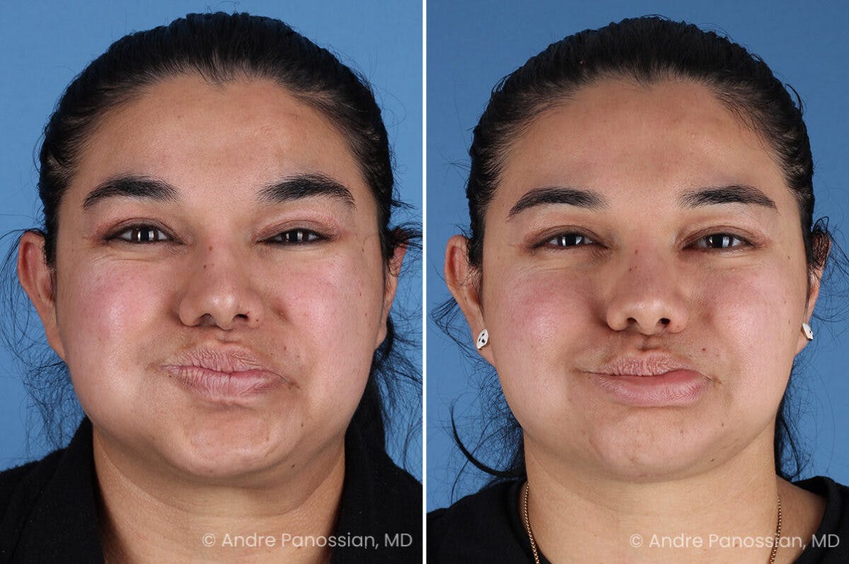 Selective Neurolysis Before & After Gallery - Patient 335645 - Image 4