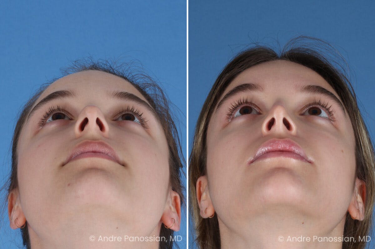 Rhinoplasty Before & After Gallery - Patient 321162 - Image 6