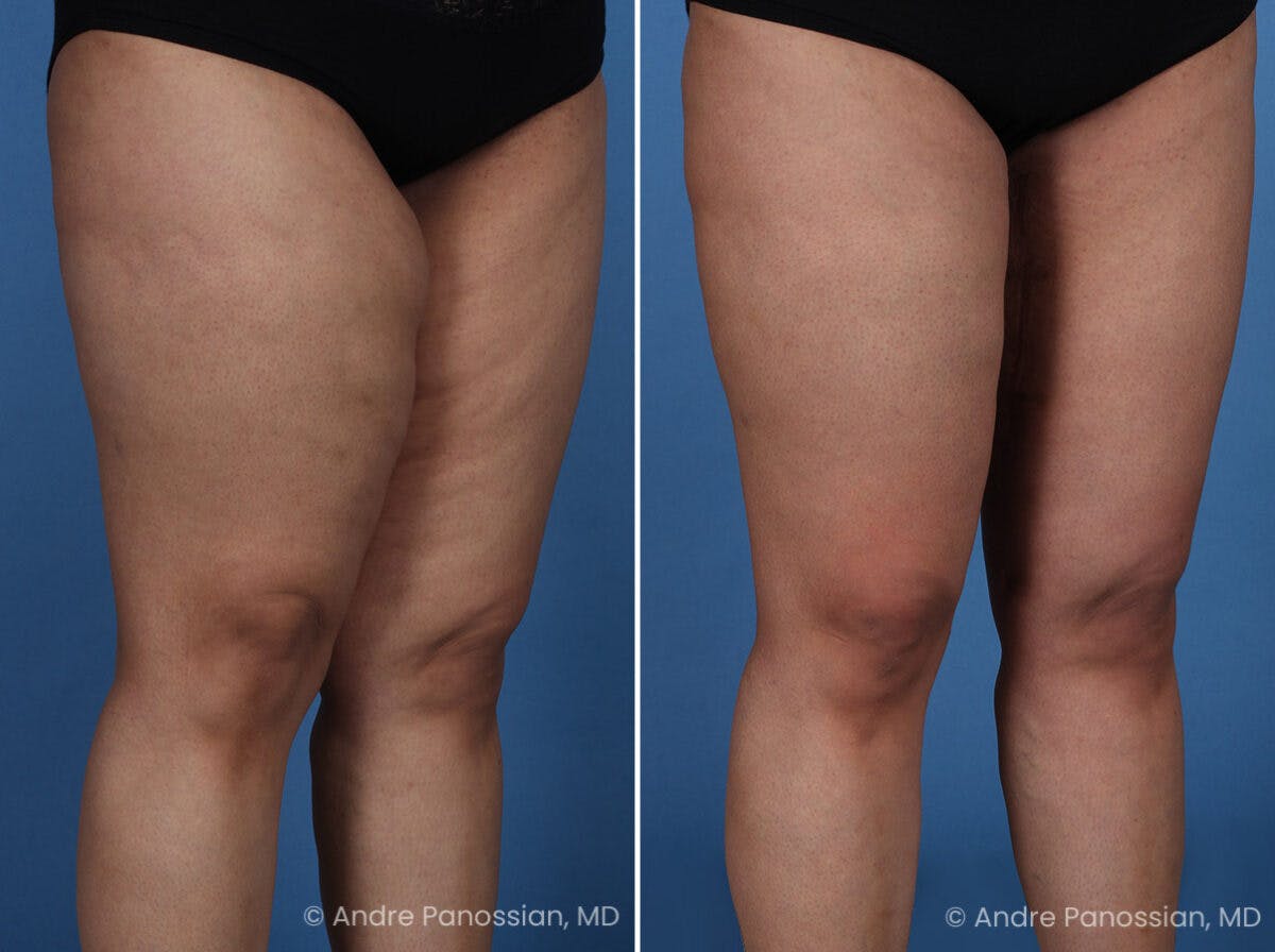Thighplasty Before & After Gallery - Patient 175563 - Image 2