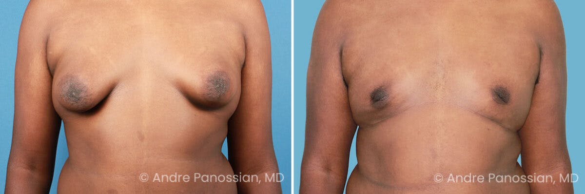 Male Breast Reduction (Gynecomastia) Before & After Gallery - Patient 411142 - Image 1