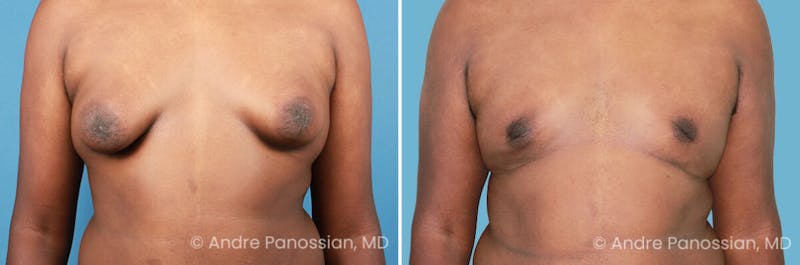 Male Breast Reduction (Gynecomastia) Before & After Gallery - Patient 411142 - Image 1