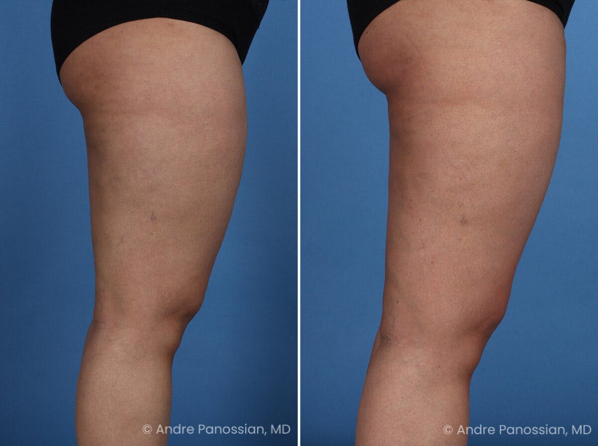 Thighplasty Before & After Gallery - Patient 175563 - Image 3