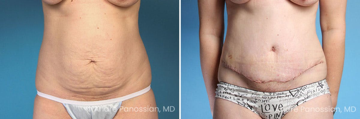 Tummy Tuck Before & After Gallery - Patient 350162 - Image 1