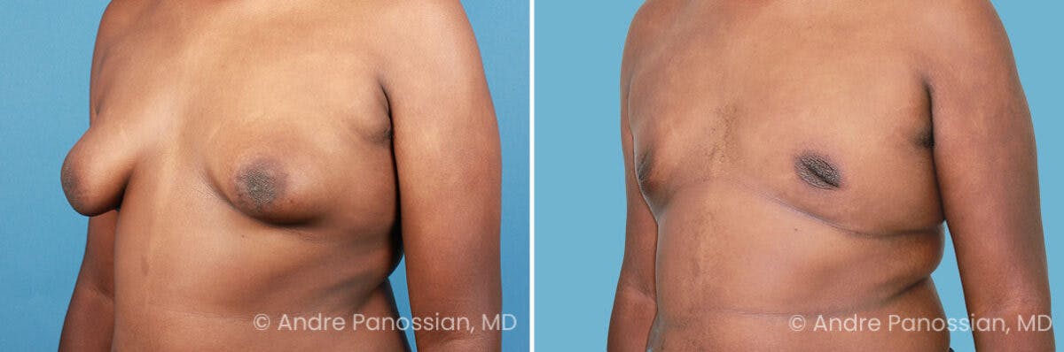 Male Breast Reduction (Gynecomastia) Before & After Gallery - Patient 411142 - Image 2