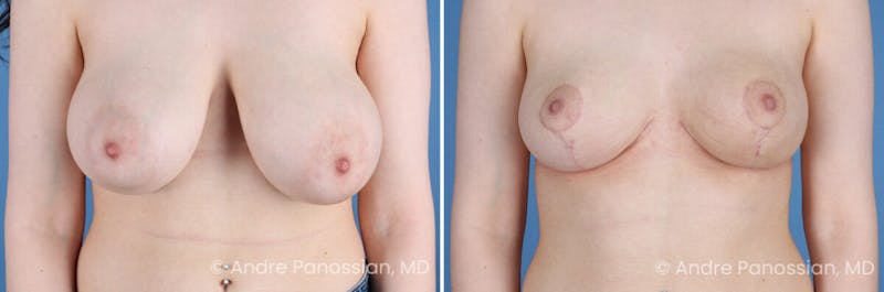 Breast Lift/Reduction Before & After Gallery - Patient 354606 - Image 1