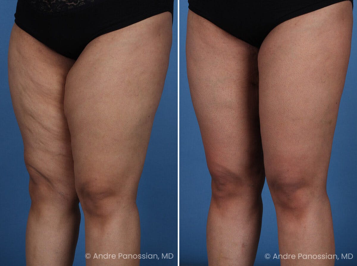 Thighplasty Before & After Gallery - Patient 175563 - Image 4