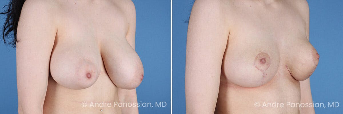 Breast Lift/Reduction Before & After Gallery - Patient 354606 - Image 2