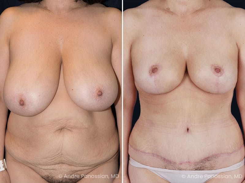 Mommy Makeover Before & After Gallery - Patient 153576 - Image 1
