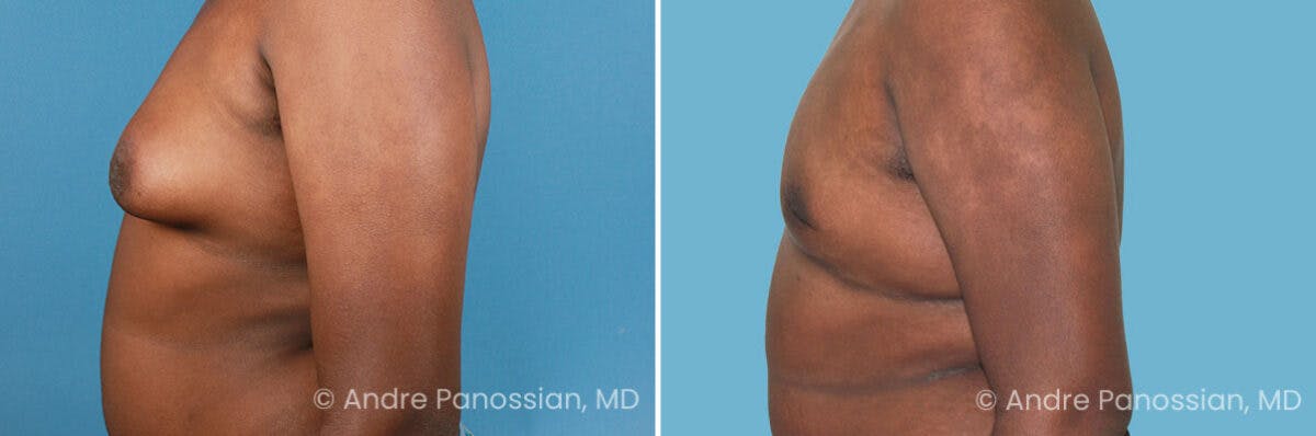 Male Breast Reduction (Gynecomastia) Before & After Gallery - Patient 411142 - Image 3