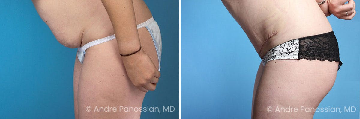 Tummy Tuck Before & After Gallery - Patient 350162 - Image 2