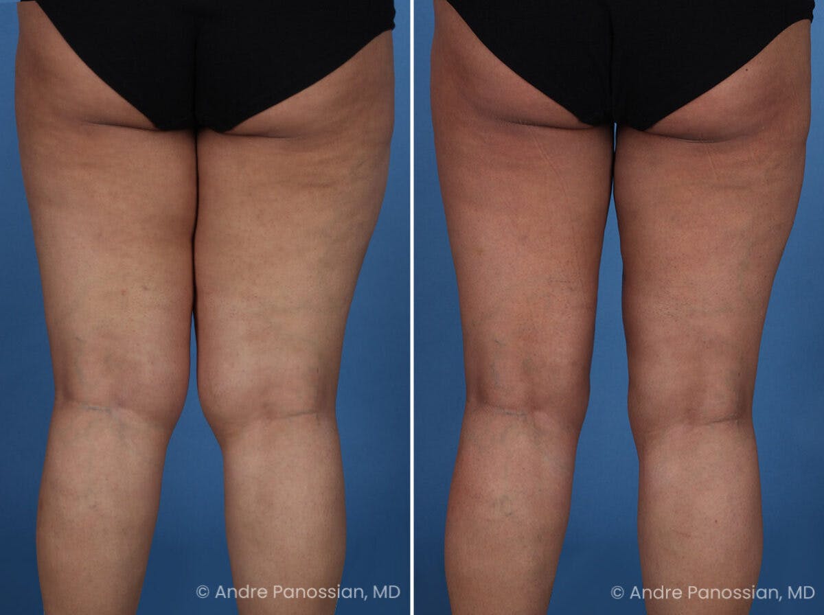 Thighplasty Before & After Gallery - Patient 175563 - Image 5