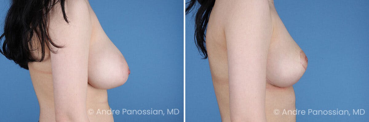 Breast Lift/Reduction Before & After Gallery - Patient 354606 - Image 3