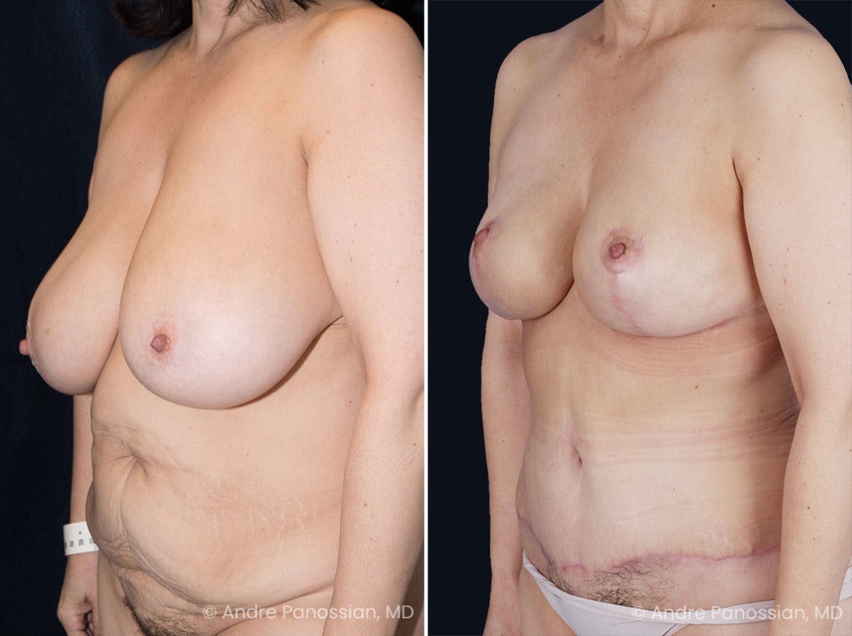 Mommy Makeover Before & After Gallery - Patient 153576 - Image 2