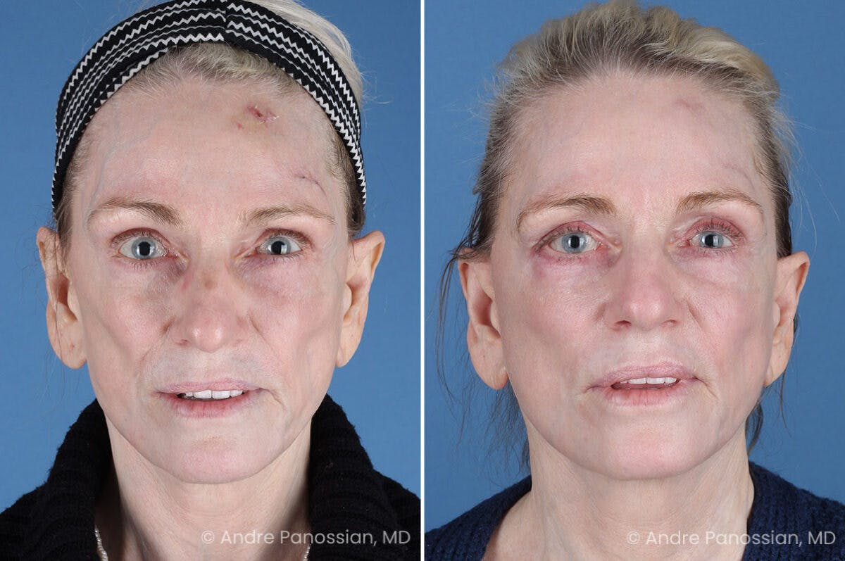 Selective Neurolysis Before & After Gallery - Patient 194529 - Image 1