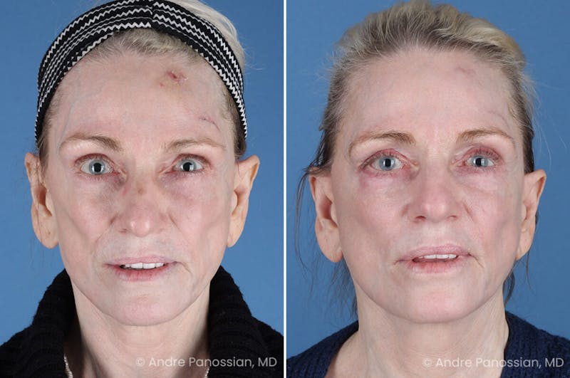 Selective Neurolysis Before & After Gallery - Patient 194529 - Image 1