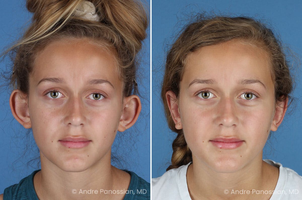 Ear Pinning (Otoplasty) Before & After Gallery - Patient 404369 - Image 1