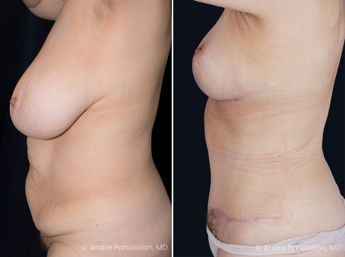 Mommy Makeover Before & After Gallery - Patient 153576 - Image 3