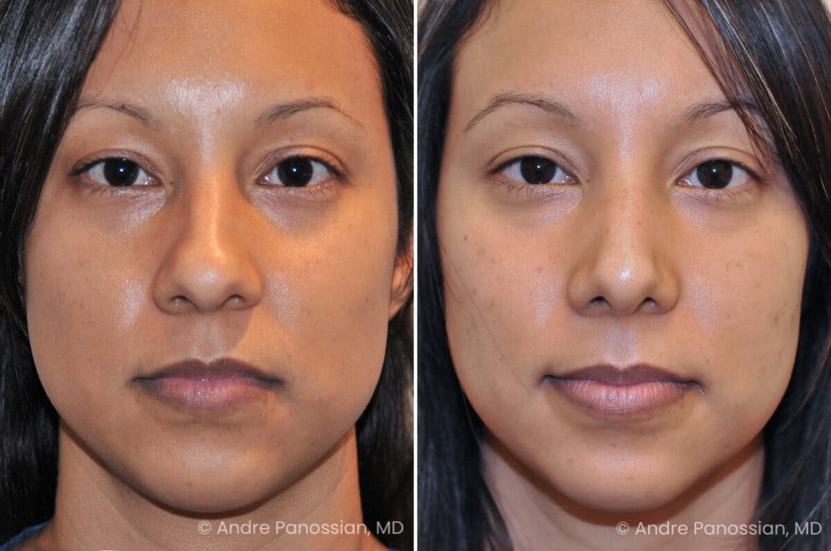 Rhinoplasty Before & After Gallery - Patient 536139 - Image 2