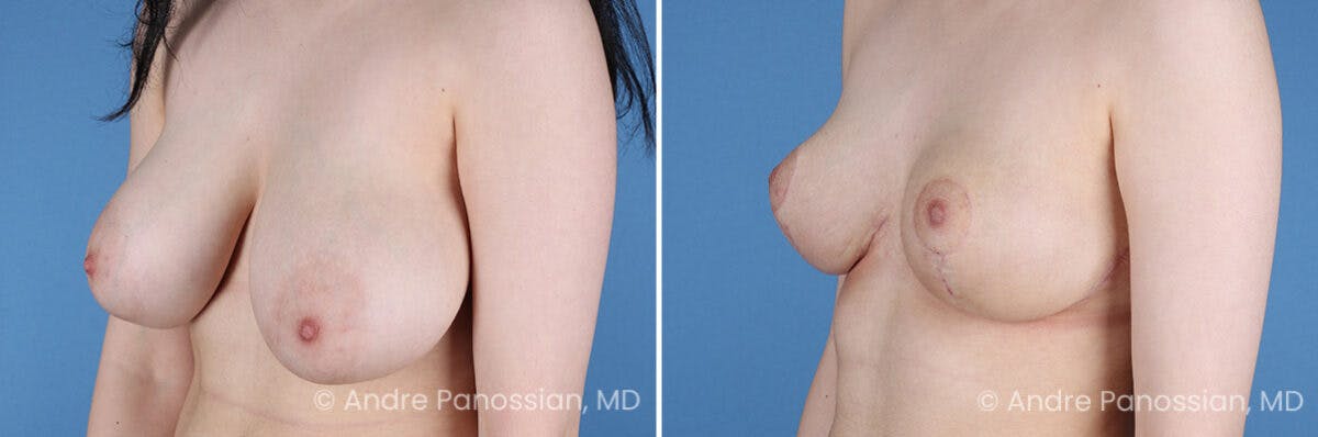 Breast Lift/Reduction Before & After Gallery - Patient 354606 - Image 4