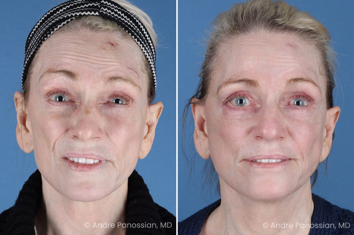 Selective Neurolysis Before & After Gallery - Patient 194529 - Image 2