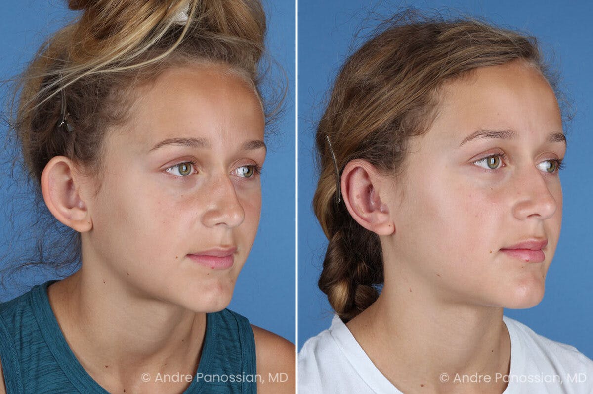 Ear Pinning (Otoplasty) Before & After Gallery - Patient 404369 - Image 2