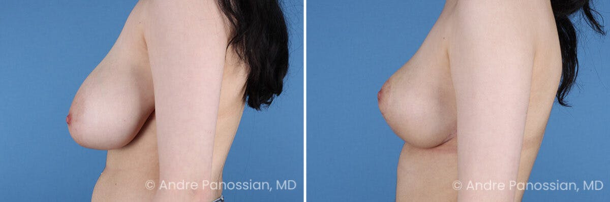 Breast Lift/Reduction Before & After Gallery - Patient 354606 - Image 5