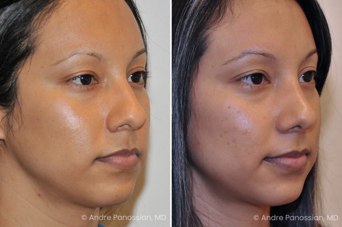 Rhinoplasty Before & After Gallery - Patient 536139 - Image 1