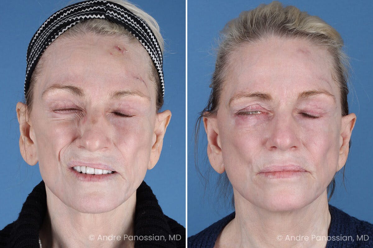 Selective Neurolysis Before & After Gallery - Patient 194529 - Image 3