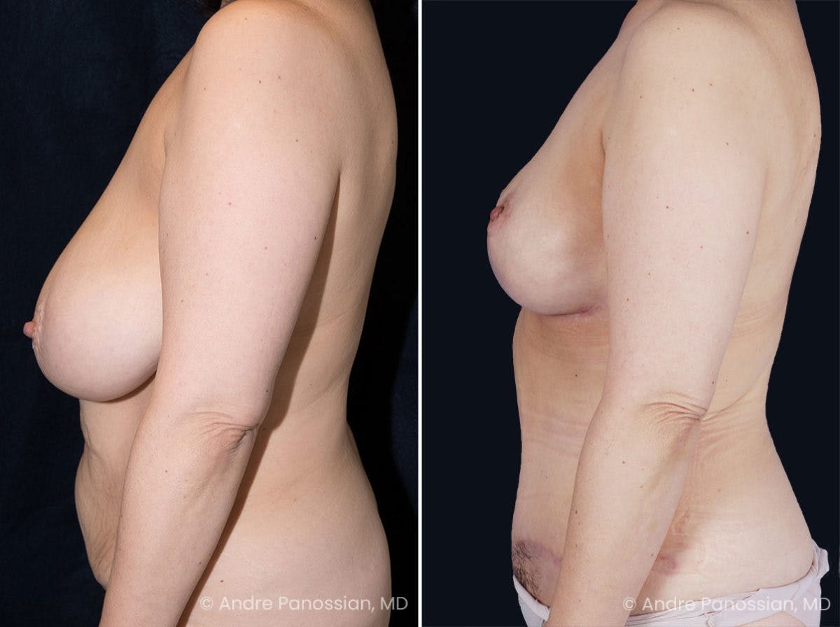 Mommy Makeover Before & After Gallery - Patient 153576 - Image 4