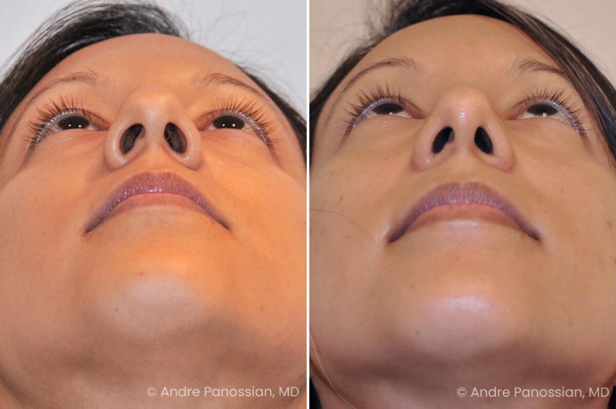 Rhinoplasty Before & After Gallery - Patient 536139 - Image 3