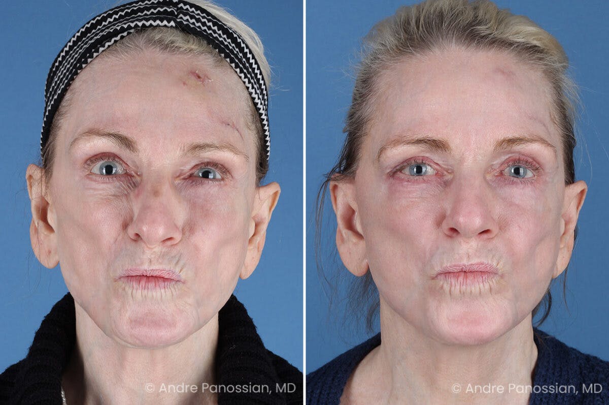 Selective Neurolysis Before & After Gallery - Patient 194529 - Image 4