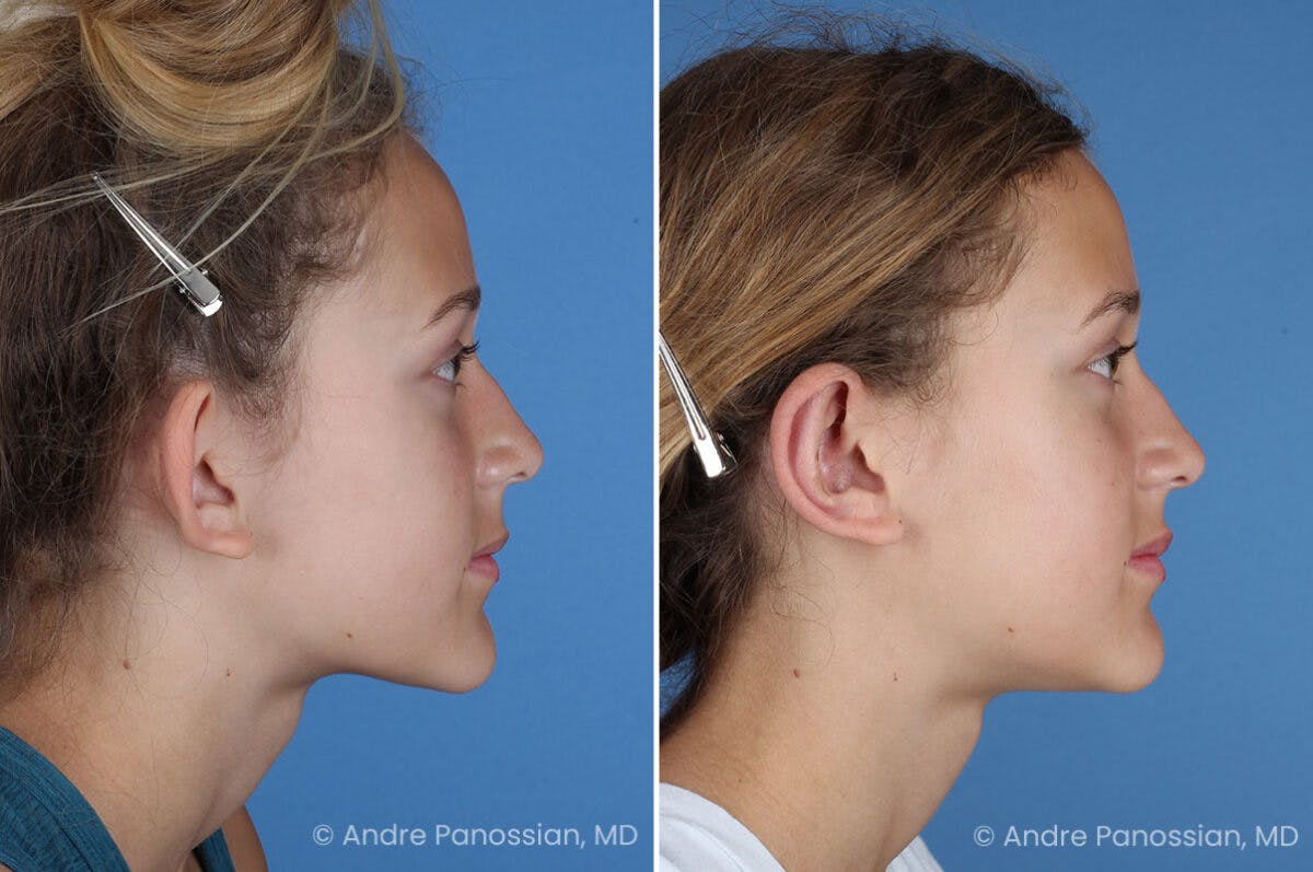 Ear Pinning (Otoplasty) Before & After Gallery - Patient 404369 - Image 3