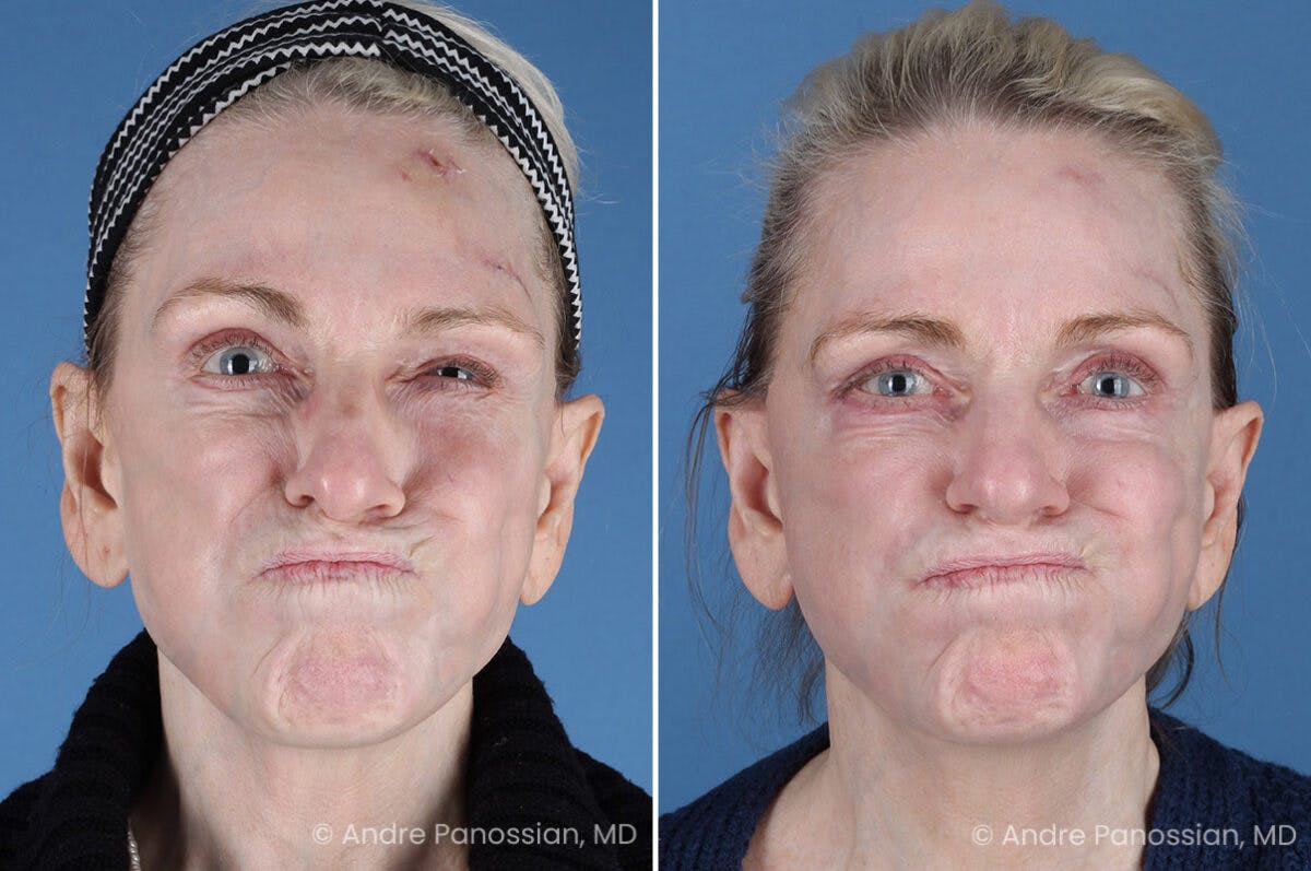 Selective Neurolysis Before & After Gallery - Patient 194529 - Image 5