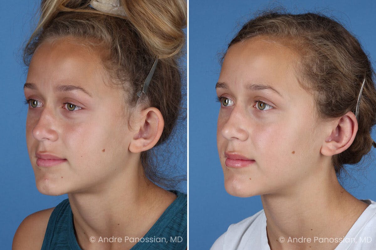 Ear Pinning (Otoplasty) Before & After Gallery - Patient 404369 - Image 4