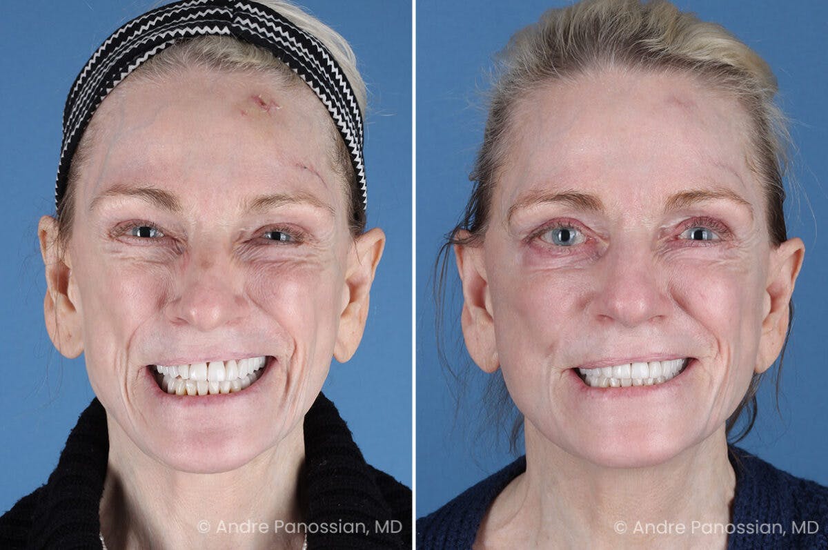 Selective Neurolysis Before & After Gallery - Patient 194529 - Image 6